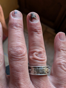 Hématomes sur les ongles